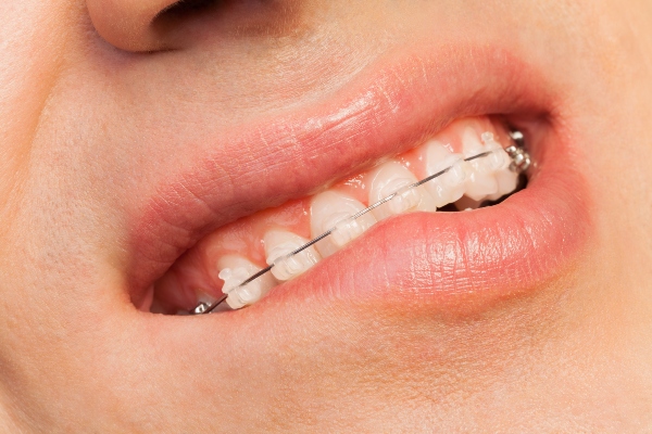 Cómo las Carillas Dentales Pueden Corregir los Dientes Torcidos